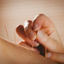 Akupunktur kann bei den verschiedensten Beschwerden schonend eingesetzt werden.